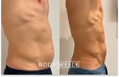 Before & After Emsculpt