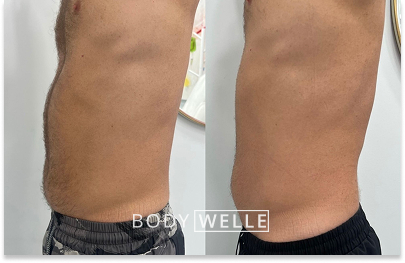 Before & After Emsculpt