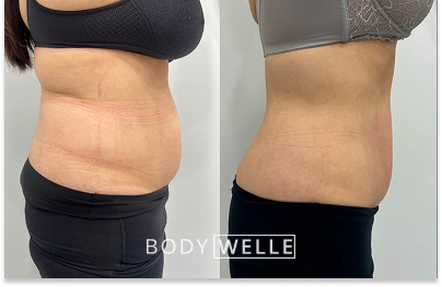 Before & After Emsculpt