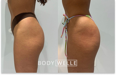 Before & After Emsculpt