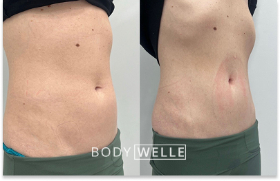 Before & After Emsculpt