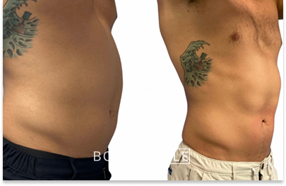 Before & After Emsculpt