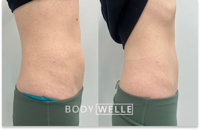 Before & After Emsculpt