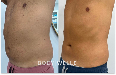 Before & After Emsculpt