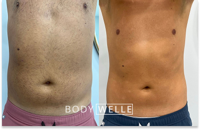 Before & After Emsculpt