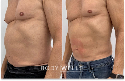 Before & After Emsculpt
