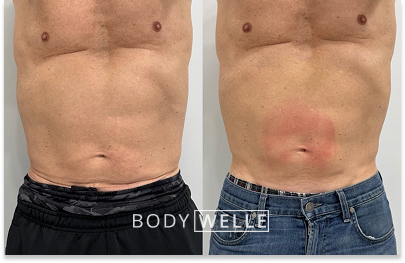 Before & After Emsculpt
