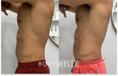 Before & After Emsculpt