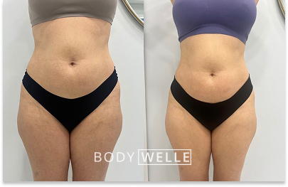 Before & After Emsculpt