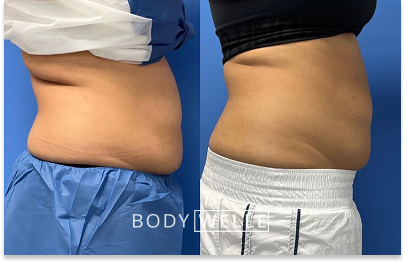 Before & After Emsculpt