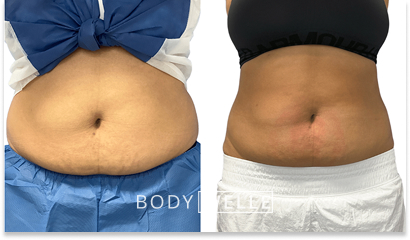 Before & After Emsculpt