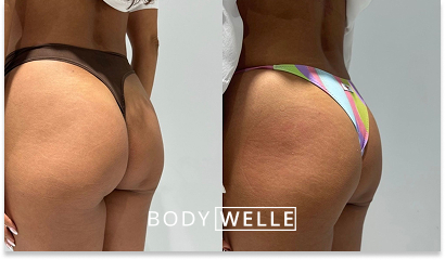 Before & After Emsculpt