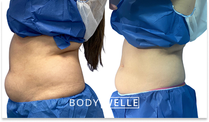 Before & After Emsculpt