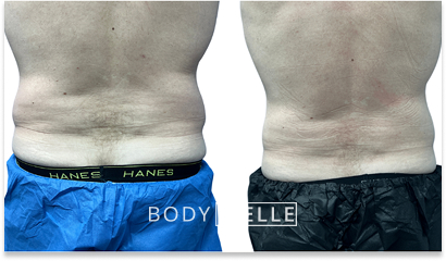 Before & After Emsculpt