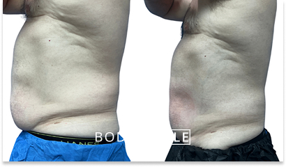 Before & After Emsculpt