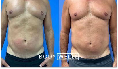 Before & After Emsculpt