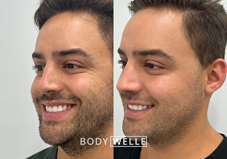 Before & After Microneedling