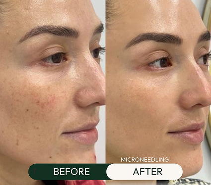 BODYWELLE microneedling before and after picture.