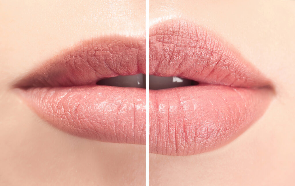 Close-up of lips showing before and after swelling from lip filler treatment, highlighting natural results.