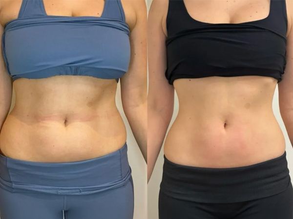 BODYWELLE details how Morpheus8 technology targets skin aging and laxity using FDA-cleared microneedling and RF techniques