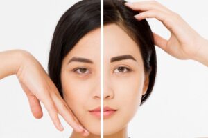 Side-by-side comparison of a woman�s face before and after Botox brow lift showing lifted brows and smoother skin.