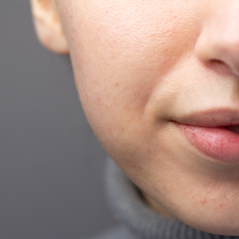 Close-up of lower face showing improved skin texture, representing Botox use for acne and sebum control.