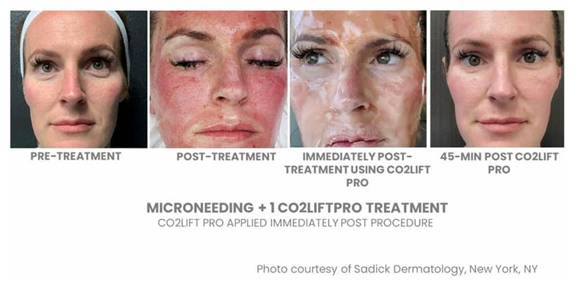 Face Skin Rejuvenation Before After Real Case 1