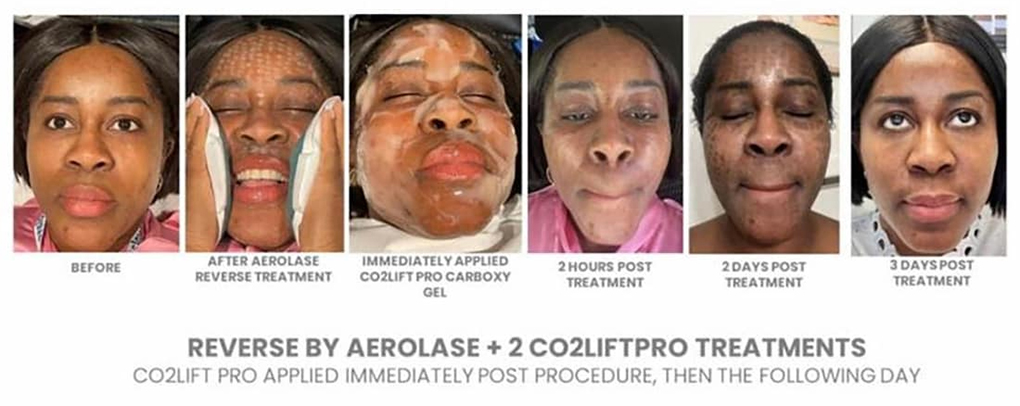 Face Skin Rejuvenation Before After Real Case 2