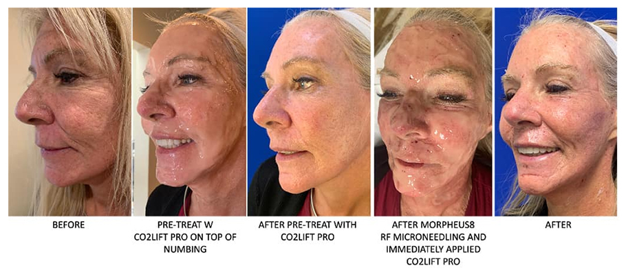 Face Skin Rejuvenation Before After Real Case 3