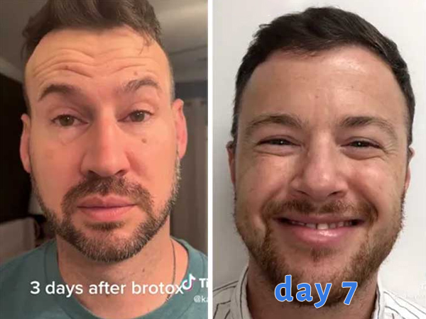Inside the Rise of ‘Brotox’
