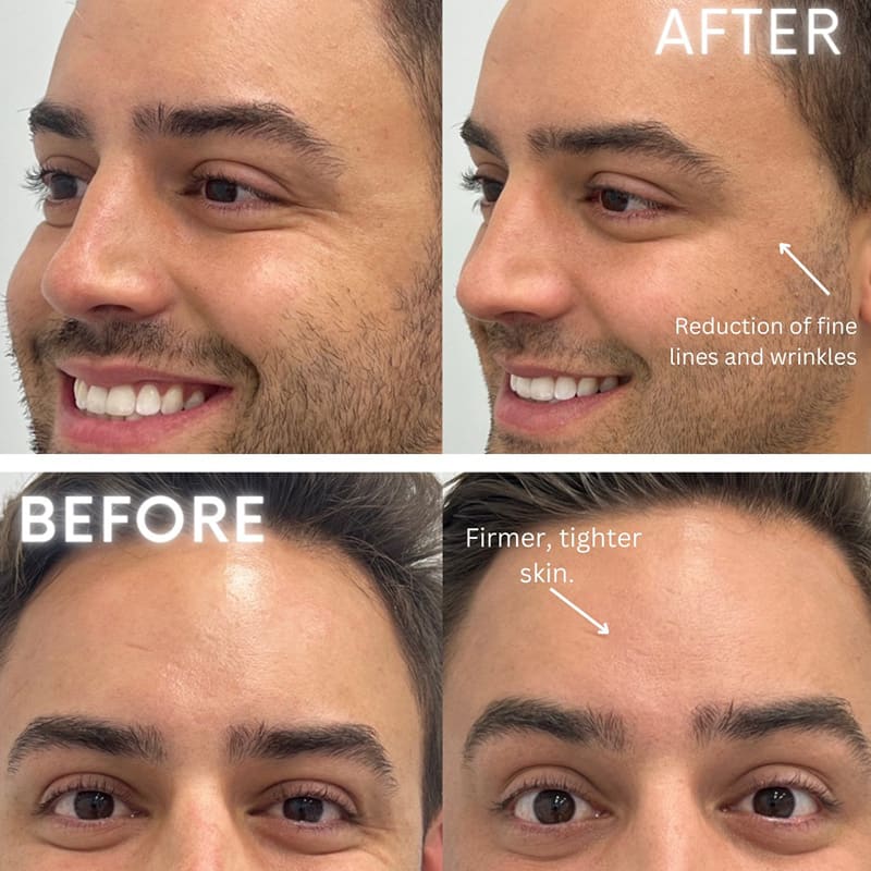 Microneedling Before After