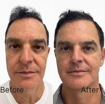 Botox Before and After Photos in Miami Beach, FL, Patient 1859