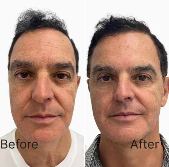 Botox Before and After Photos in Miami Beach, FL, Patient 1859