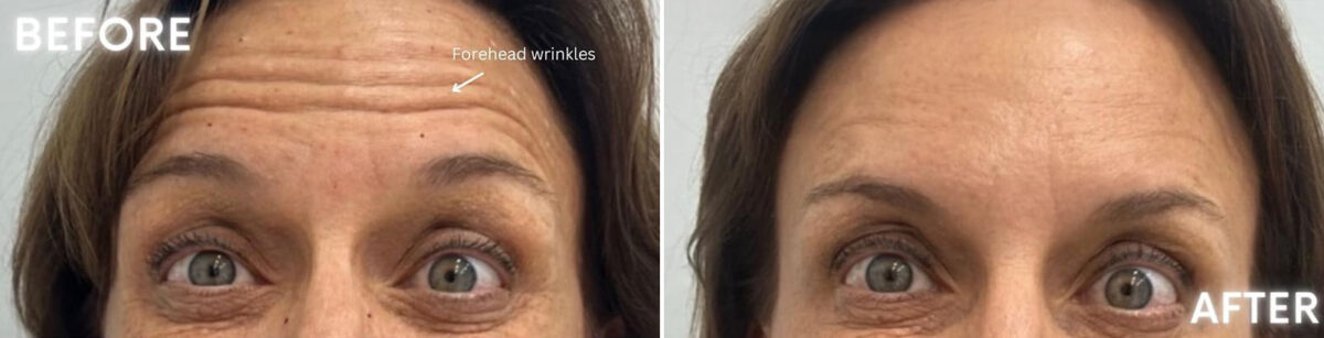 Botox Before and After Photos in Miami Beach, FL, Patient 2171