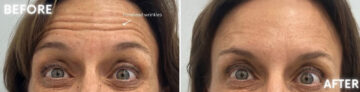 Botox Before and After Photos in Miami Beach, FL, Patient 2171