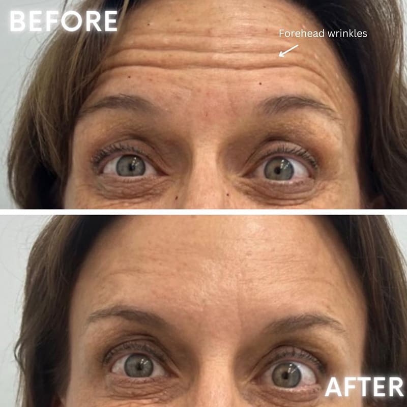 Patient 2171 Botox Before After Cover