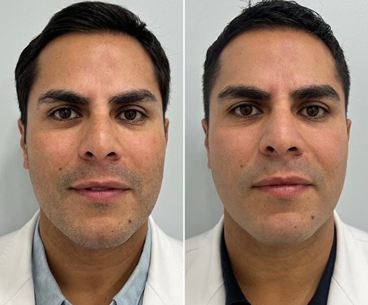 Clear & Brilliant Before and After Photos in Miami Beach, FL, Patient 2175