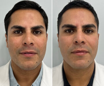 Clear & Brilliant Before and After Photos in Miami Beach, FL, Patient 2175