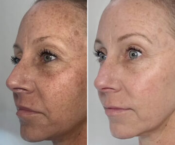 Clear & Brilliant Before and After Photos in Miami Beach, FL, Patient 2182