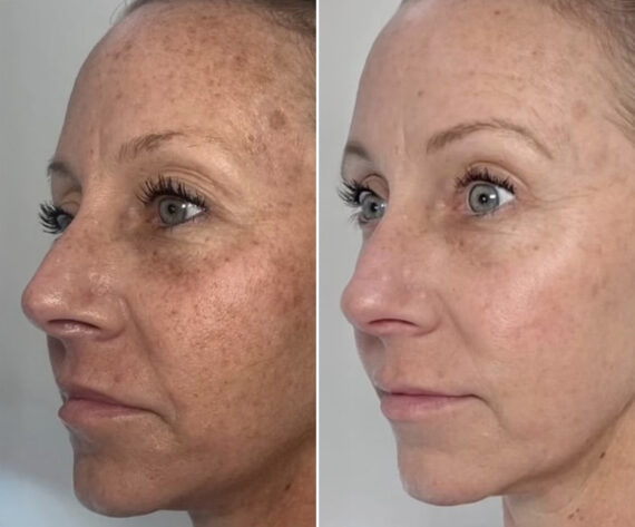 Clear & Brilliant Before and After Photos in Miami Beach, FL, Patient 2182