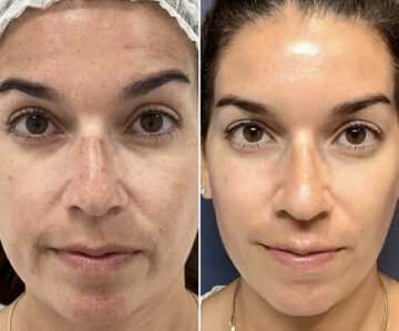 Clear & Brilliant Before and After Photos in Miami Beach, FL, Patient 2189