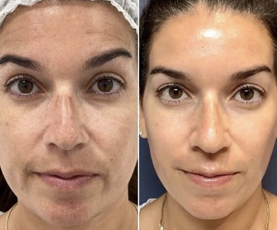 Clear & Brilliant Before and After Photos in Miami Beach, FL, Patient 2189