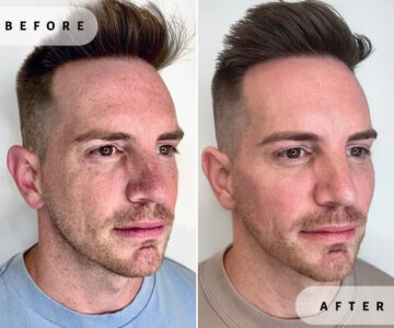 Clear & Brilliant Before and After Photos in Miami Beach, FL, Patient 2207