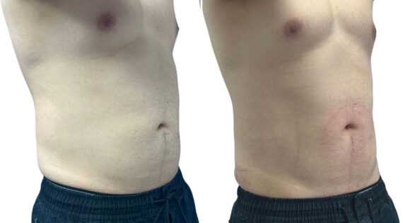 EMSculpt NEO Before and After Photos in Miami Beach, FL, Patient 2260