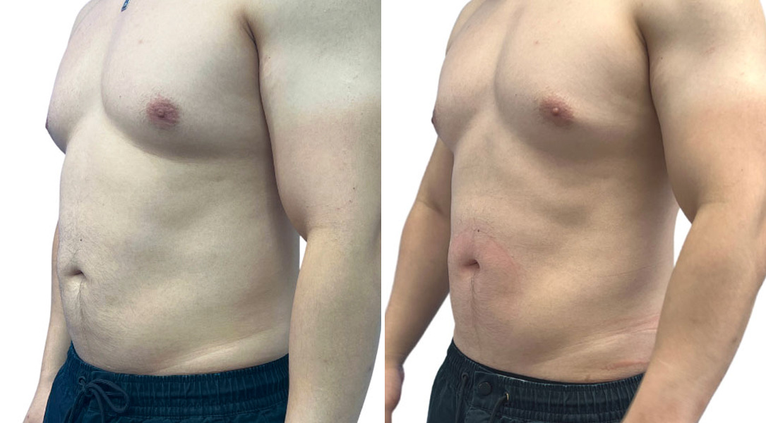 EMSculpt NEO Before and After Photos in Miami Beach, FL, Patient 2260