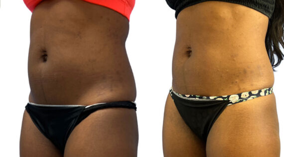 EMSculpt NEO Before and After Photos in Miami Beach, FL, Patient 2282