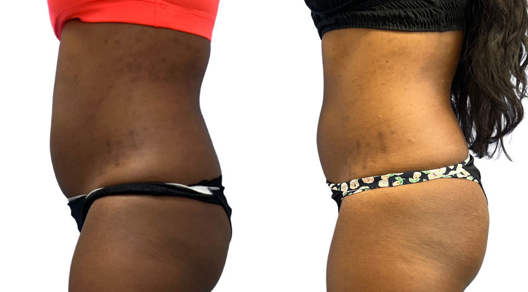 EMSculpt NEO Before and After Photos in Miami Beach, FL, Patient 2282