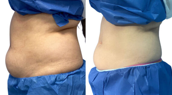 EMSculpt NEO Before and After Photos in Miami Beach, FL, Patient 2284