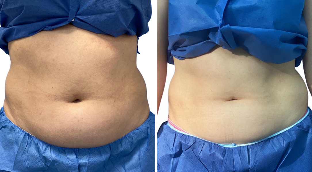 EMSculpt NEO Before and After Photos in Miami Beach, FL, Patient 2284