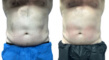 EMSculpt NEO Before and After Photos in Miami Beach, FL, Patient 2286